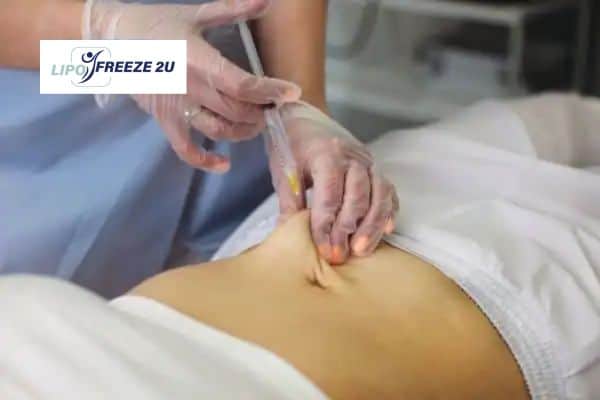 How Does Aqualyx Fat Dissolving Injection Work to Break Down Fat Maidenhead?