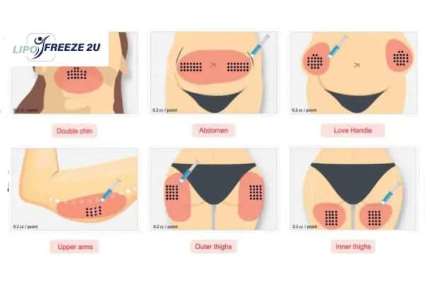 Benefits of Choosing Aqualyx for Fat Reduction Maidenhead