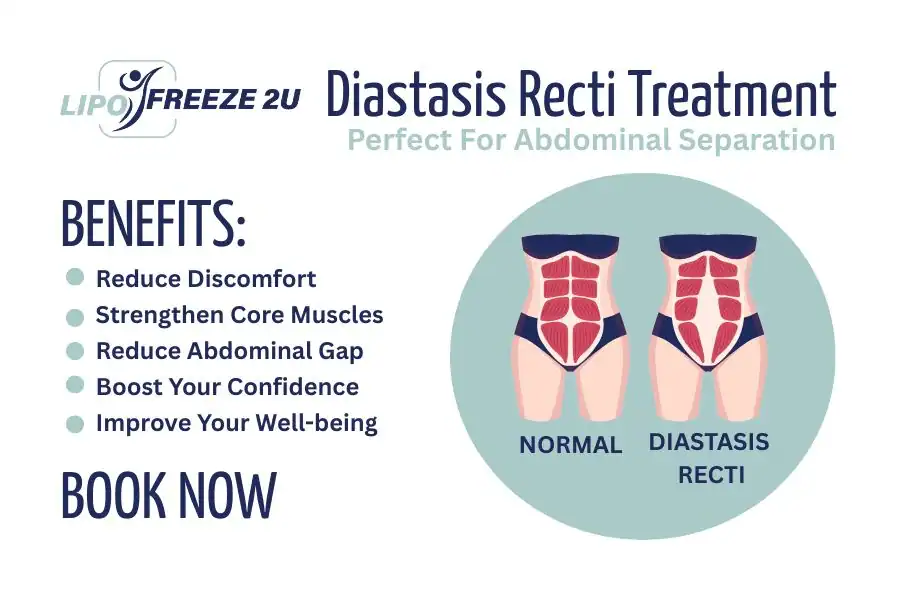 Benefits of body toning treatment Maidenhead for Diastasis recti
