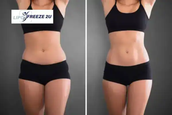 How Can LIPO FREEZE 2U Support Your Post-Pregnancy Body Recovery Maidenhead?
