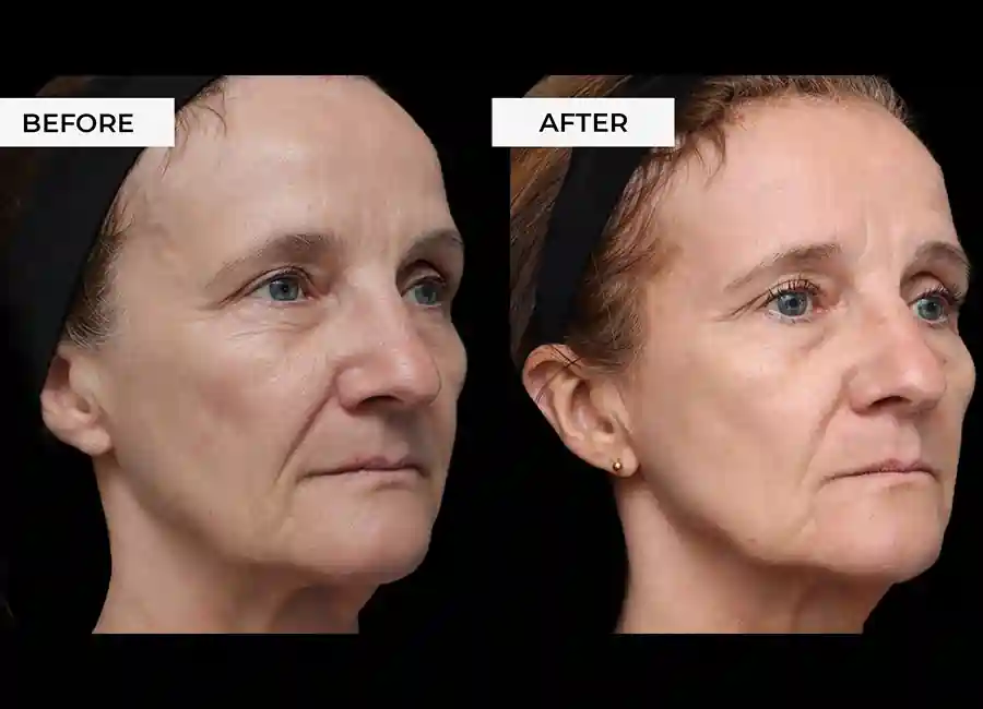 How Many RF Microneedling Sessions Will You Need to See a Difference Maidenhead?