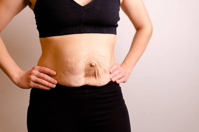 Is Surgery Really the Only Way to Repair Diastasis Recti Maidenhead?