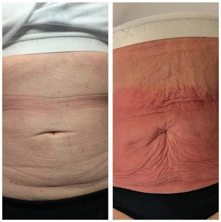 How Does RF Microneedling Improve Crepey, Thin and Uneven Skin Texture Maidenhead?
