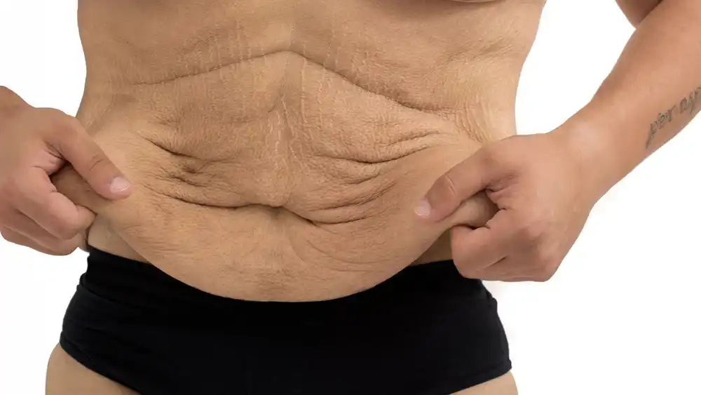 Why Does Weight Loss Medication Leave Some People With Loose or Sagging Skin Maidenhead?